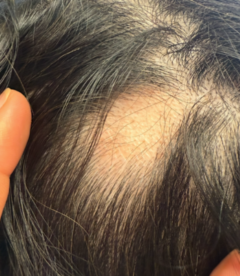 Before photo of a patient hair transformation