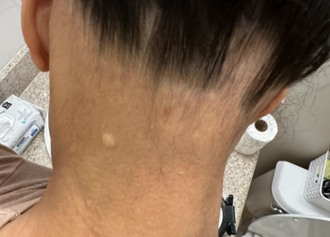 Before photo of a patient hair transformation