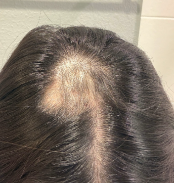 After photo of a patient hair transformation