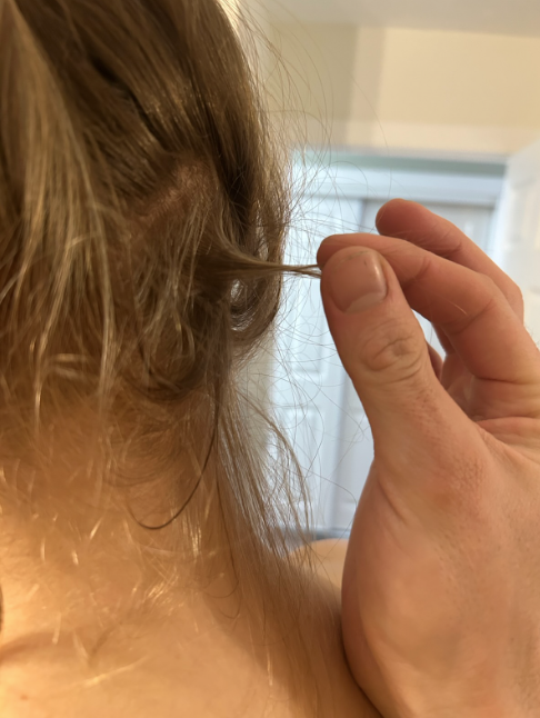 After photo of a patient hair transformation