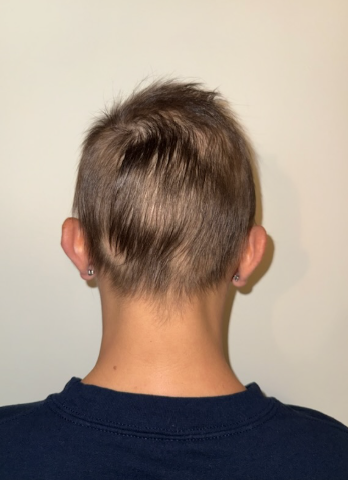 After photo of a patient hair transformation
