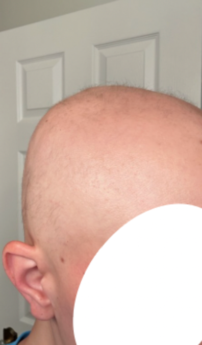 Before photo of a patient hair transformation