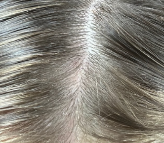 After photo of a patient hair transformation
