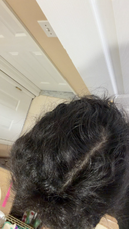 After photo of a patient hair transformation