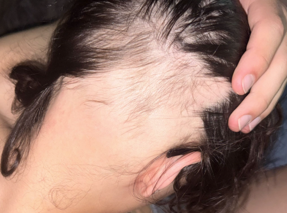 Before photo of a patient hair transformation