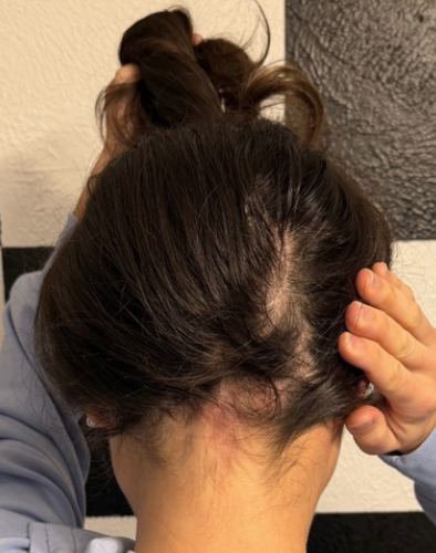 After photo of a patient hair transformation