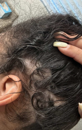 After photo of a patient hair transformation