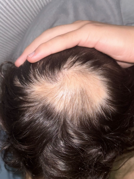 Before photo of a patient hair transformation