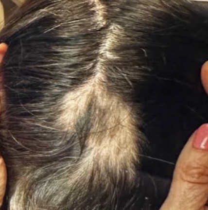 After photo of a patient hair transformation