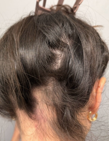 Before photo of a patient hair transformation