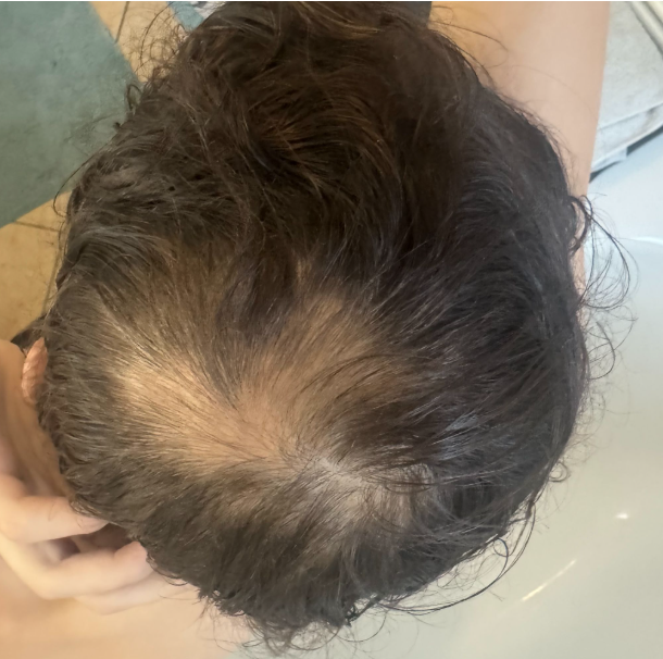 After photo of a patient hair transformation