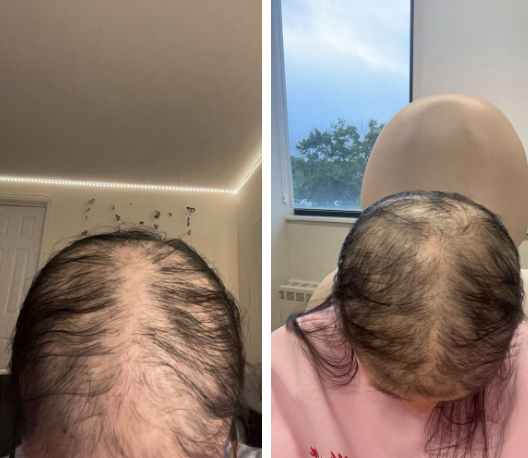 Before photo of a patient hair transformation