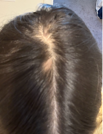 Before photo of a patient hair transformation