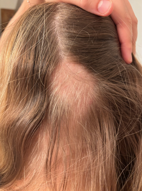 Before photo of a patient hair transformation