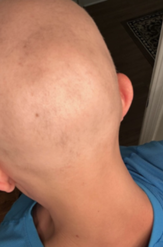 Before photo of a patient hair transformation