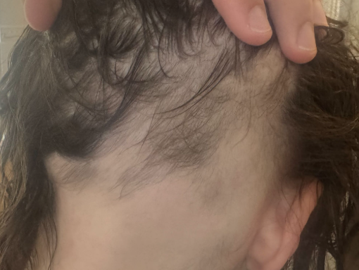 After photo of a patient hair transformation