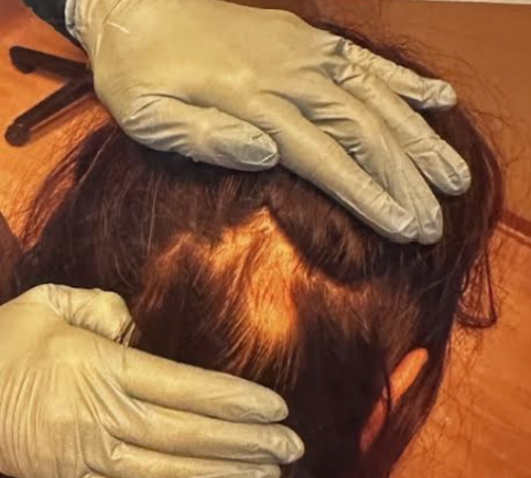 Before photo of a patient hair transformation