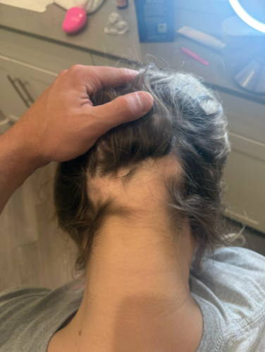 Before photo of a patient hair transformation