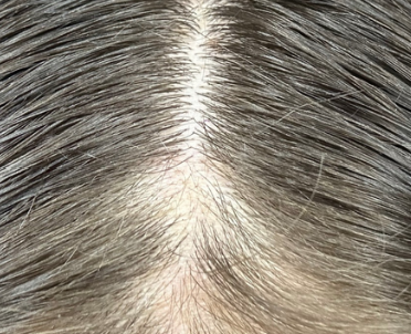 Before photo of a patient hair transformation