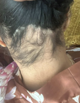 After photo of a patient hair transformation