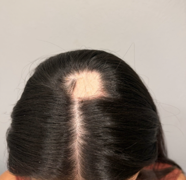 Before photo of a patient hair transformation