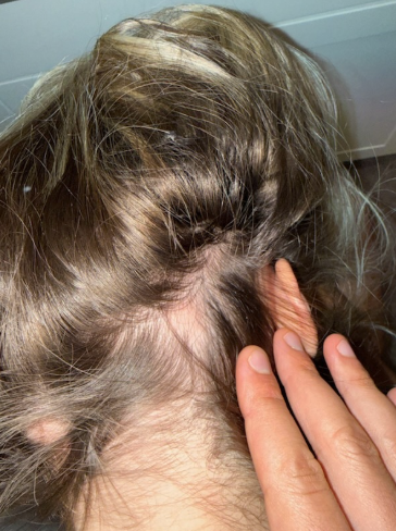 After photo of a patient hair transformation