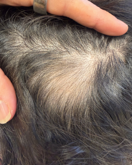 After photo of a patient hair transformation