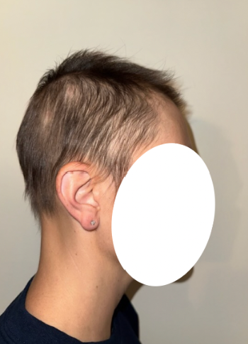 After photo of a patient hair transformation